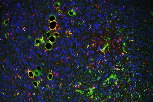 breast tumor microenvironment